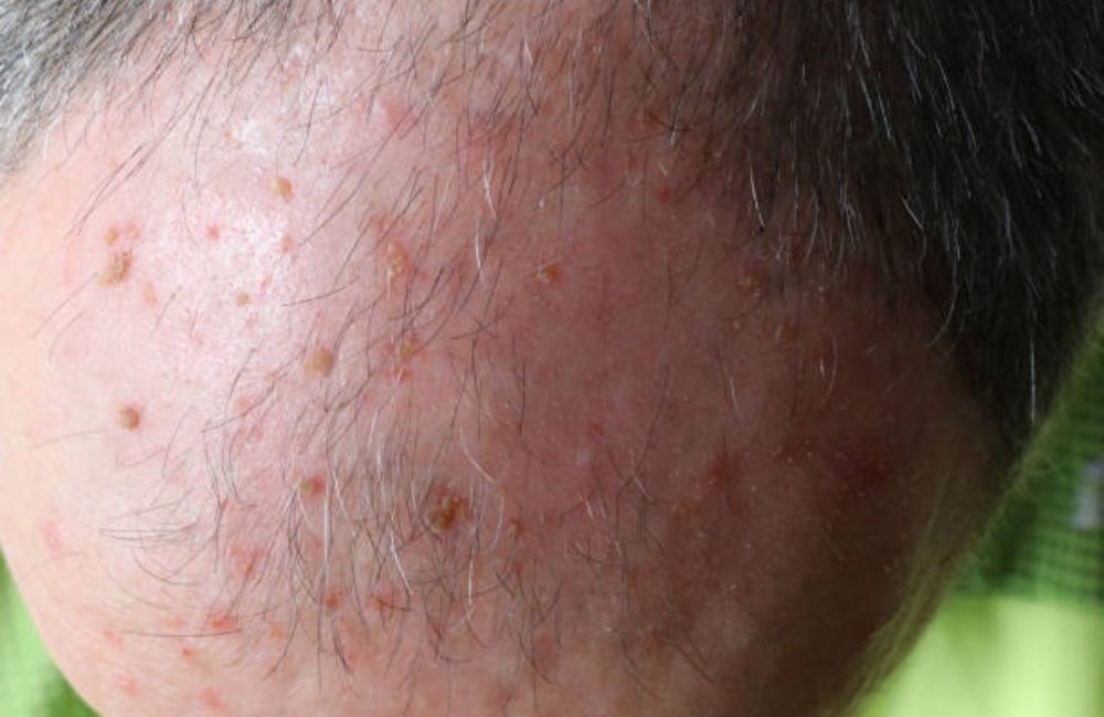 cryotherapy-actinic-keratosis-scalp Side-by-side comparison of a woman's neck before and after platysmal band injections.
