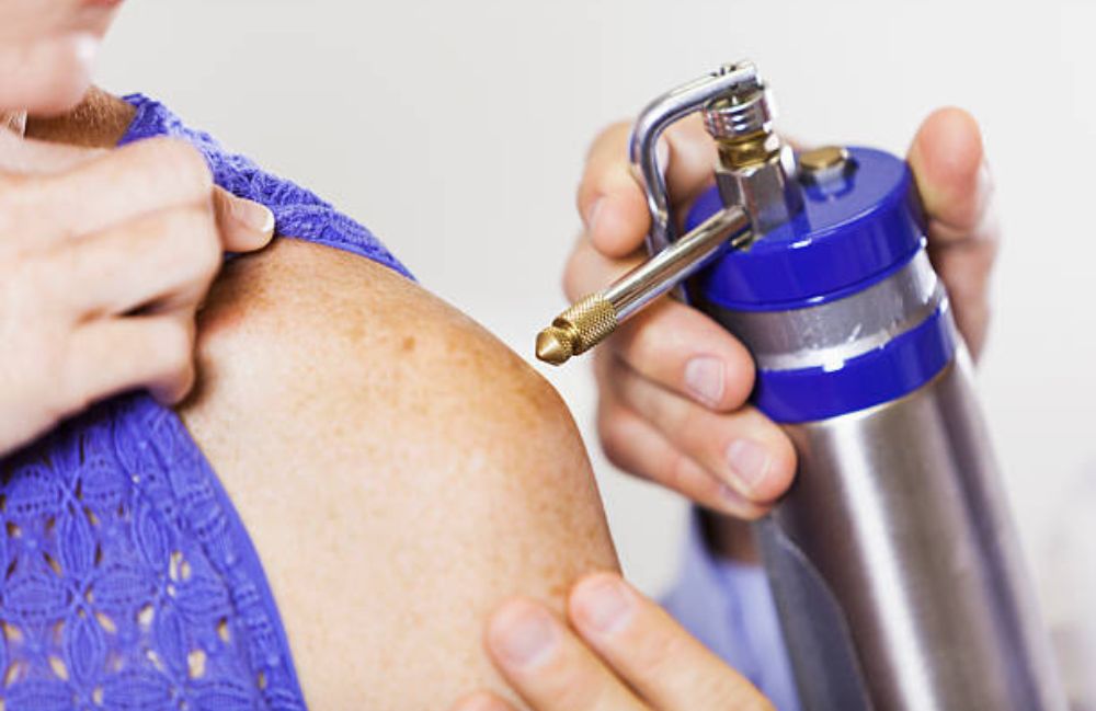 cryotherapy-liquid-nitrogen-treatment Close-up of a woman's neck showing visible platysmal bands before treatment.