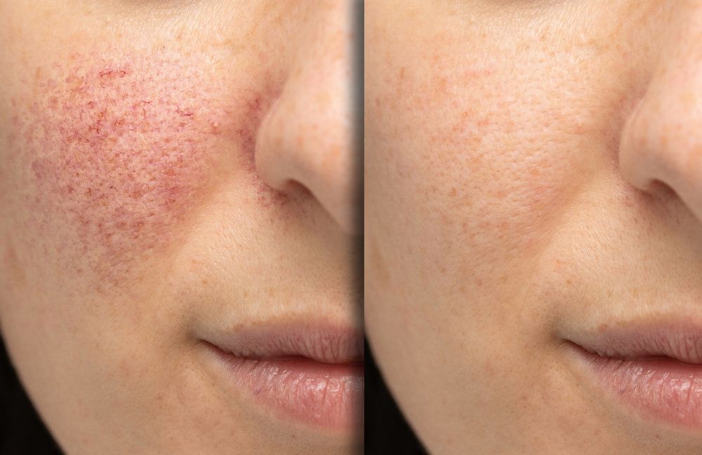 dermav-laser-vascular-lesion Side-by-side comparison of a woman's neck before and after platysmal band injections.