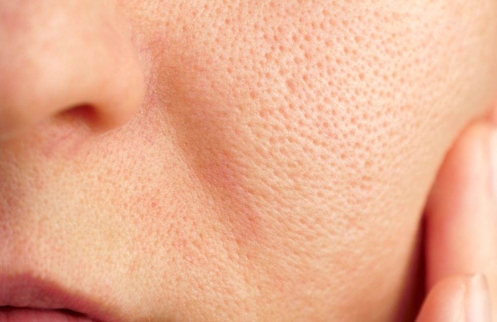 enlarged-pores-cheek-closeup Close-up of a woman's neck showing visible platysmal bands before treatment.