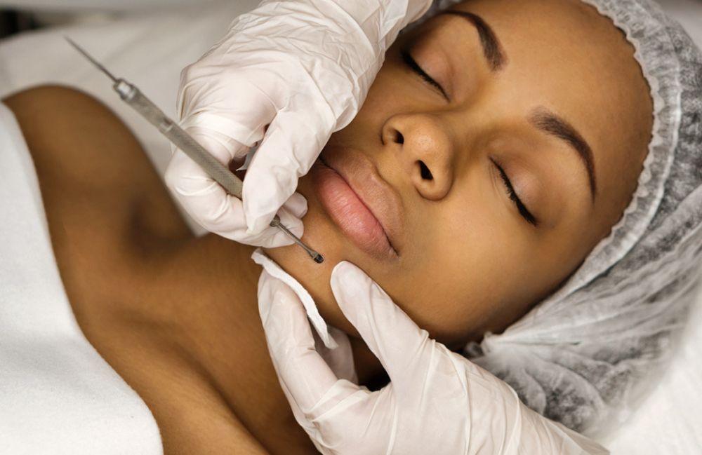 extraction-facial-tool-treatment Close-up of a woman's neck showing visible platysmal bands before treatment.