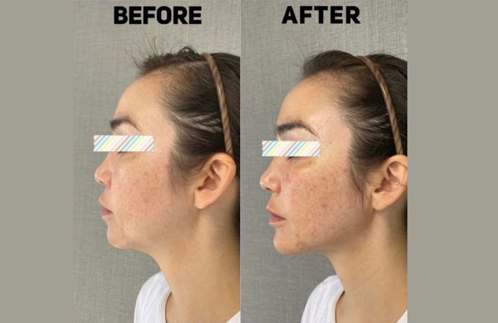 facial-slimming-before-after Side-by-side comparison of a woman's neck before and after platysmal band injections.