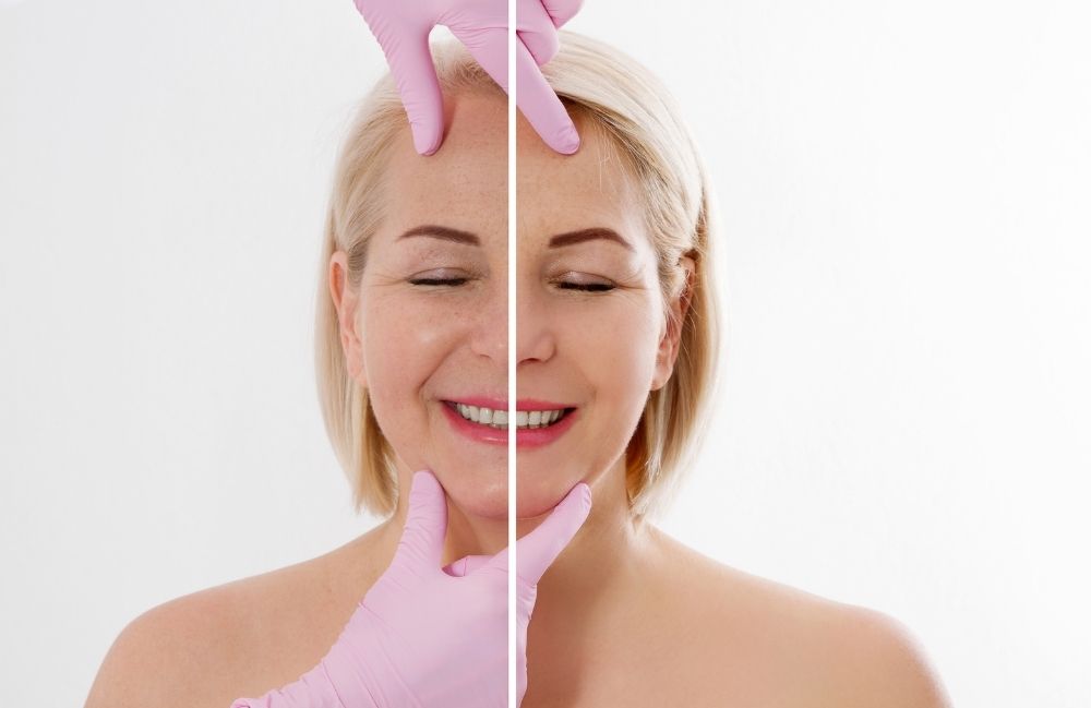 fractional-co2-laser-before-after Side-by-side comparison of a woman's neck before and after platysmal band injections.