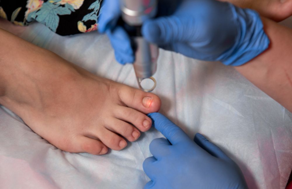 fungal-infections 1 Acne Scarring Metropolis Dermatology Los Angeles