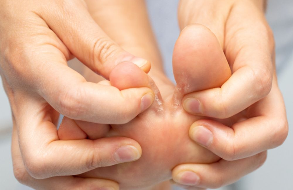 fungal-infections 2 Acne Scarring Metropolis Dermatology Los Angeles