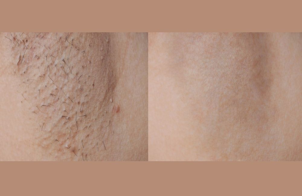 Side-by-side comparison of a woman's neck before and after platysmal band injections.