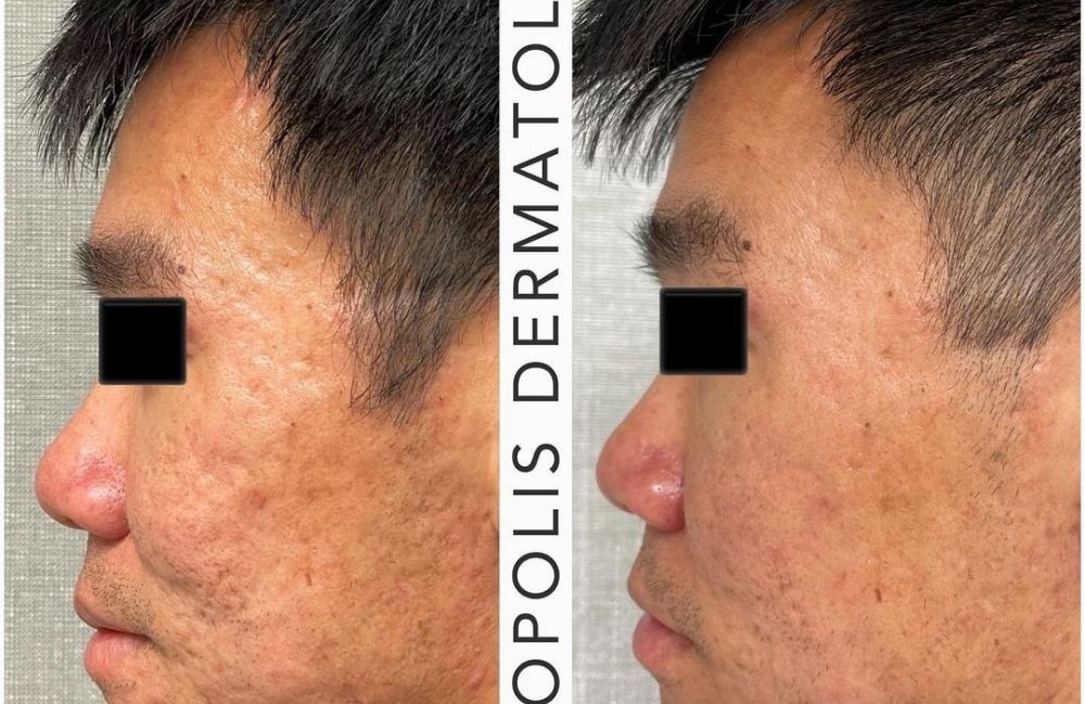 laser-scar-treatment-before-after Side-by-side comparison of a woman's neck before and after platysmal band injections.