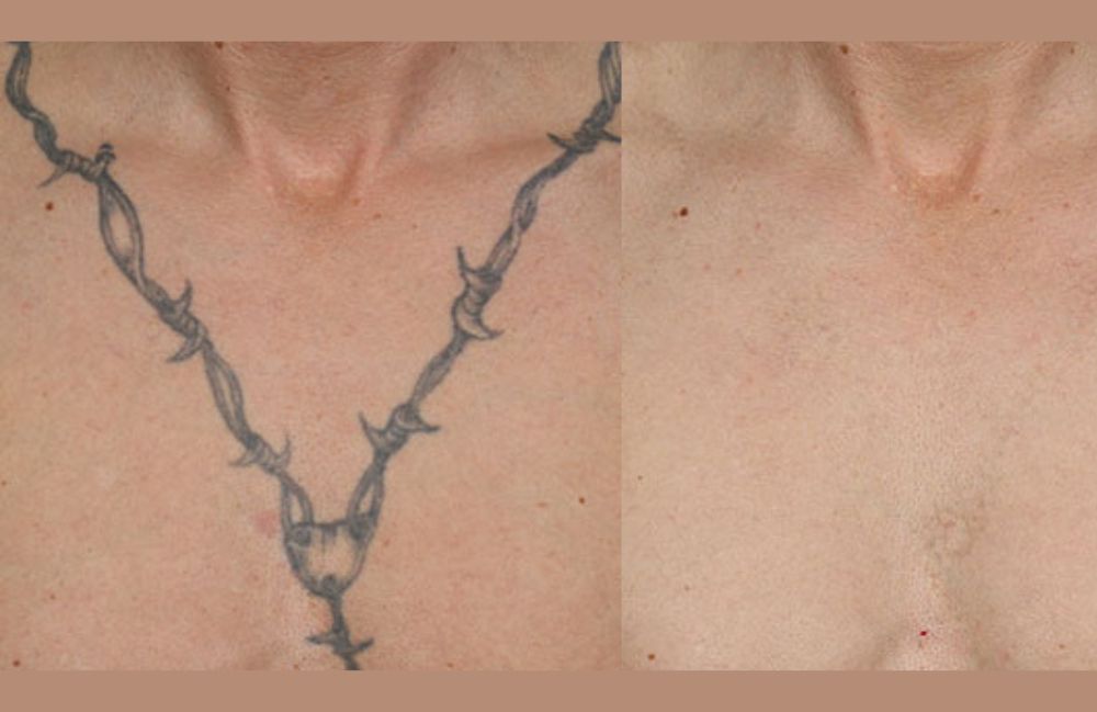 laser-tattoo-removal-chest-results Close-up of a woman's neck showing visible platysmal bands before treatment.