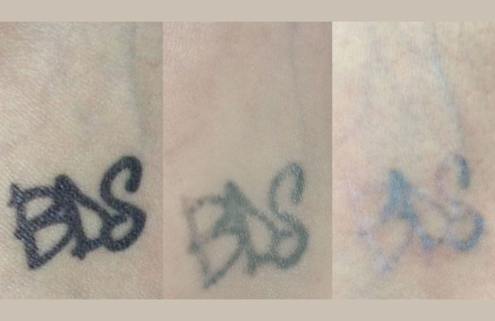 laser-tattoo-removal-progress-fade Side-by-side comparison of a woman's neck before and after platysmal band injections.