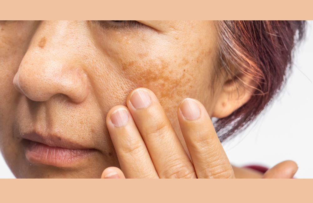 melasma-dark-spots-cheek-woman Close-up of a woman's neck showing visible platysmal bands before treatment.