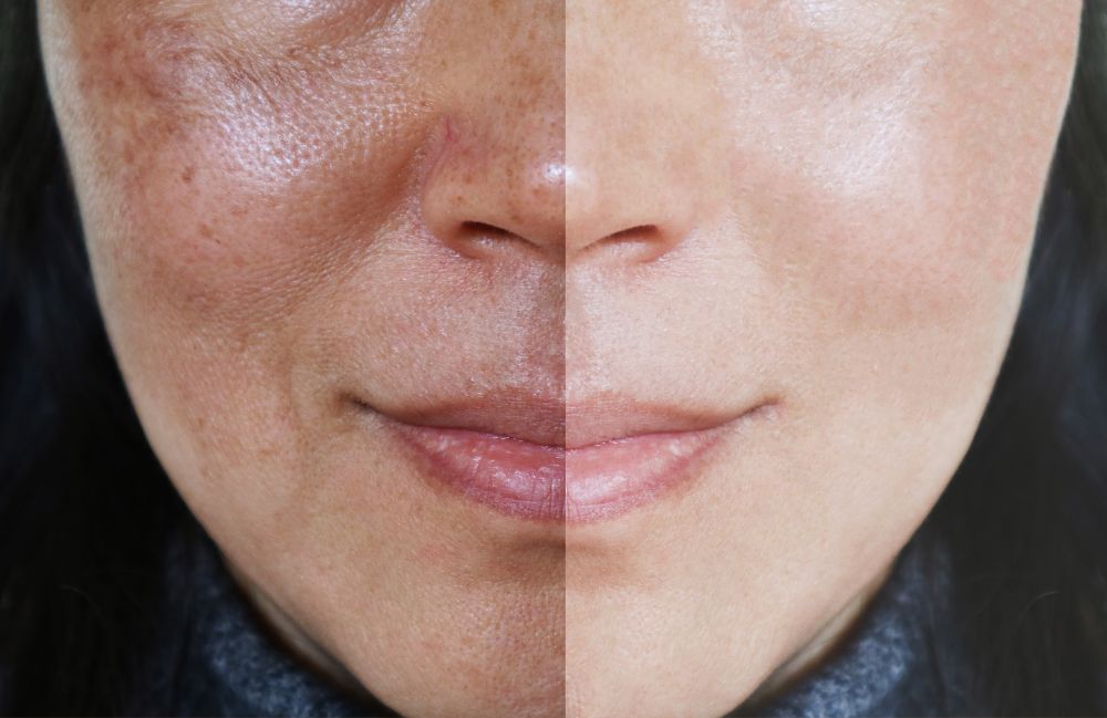 melasma-treatment-before-after-results Side-by-side comparison of a woman's neck before and after platysmal band injections.