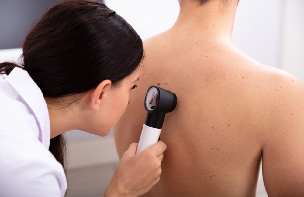 mole-check-pasadena-dermatologist Acne Scarring Metropolis Dermatology Los Angeles
