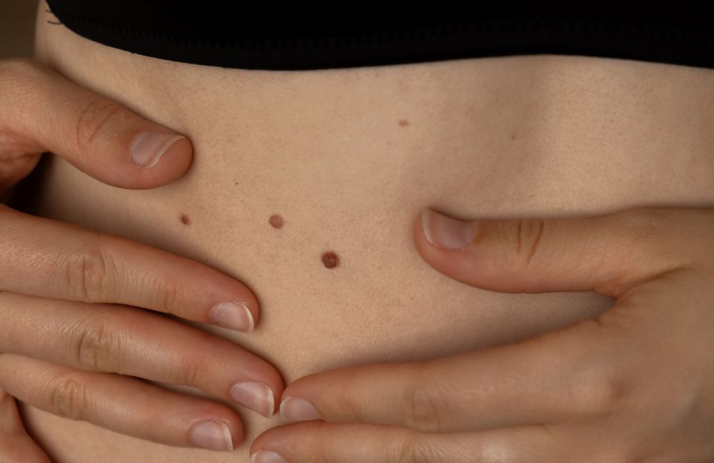 mole-skin-check-abdomen Acne Scarring Metropolis Dermatology Los Angeles