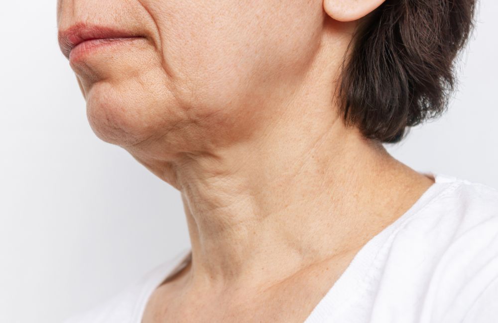 neck-tightening-loose-skin-before Side-by-side comparison of a woman's neck before and after platysmal band injections.