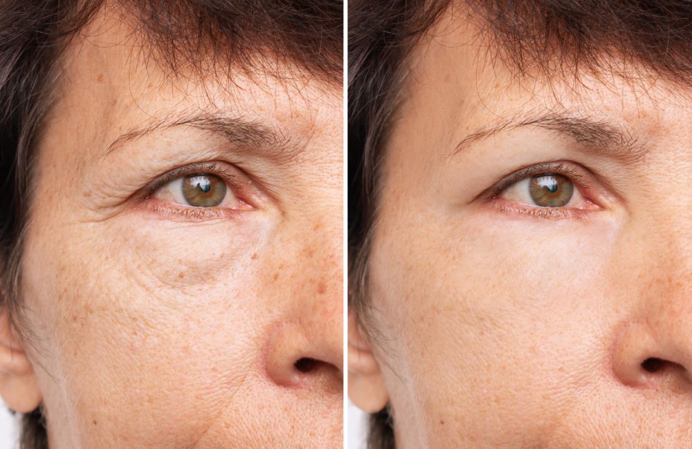 restylane_before_after_treatment Side-by-side comparison of a woman's neck before and after platysmal band injections.