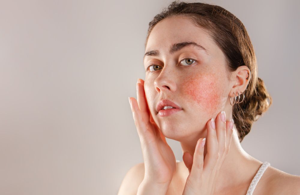 rosacea-facial-redness-woman Acne Scarring Metropolis Dermatology Los Angeles