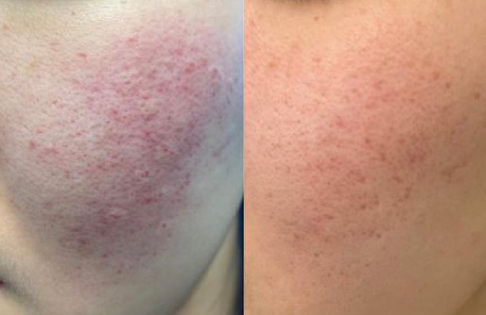 rosacea-treatment-before-after Acne Scarring Metropolis Dermatology Los Angeles