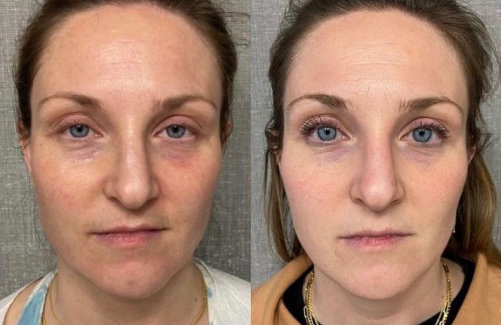 skin-tightening-before-after-face Side-by-side comparison of a woman's neck before and after platysmal band injections.