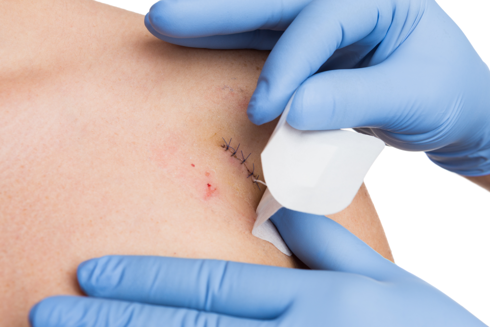 Close-up of skin cancer surgery stitches being covered with a bandage.