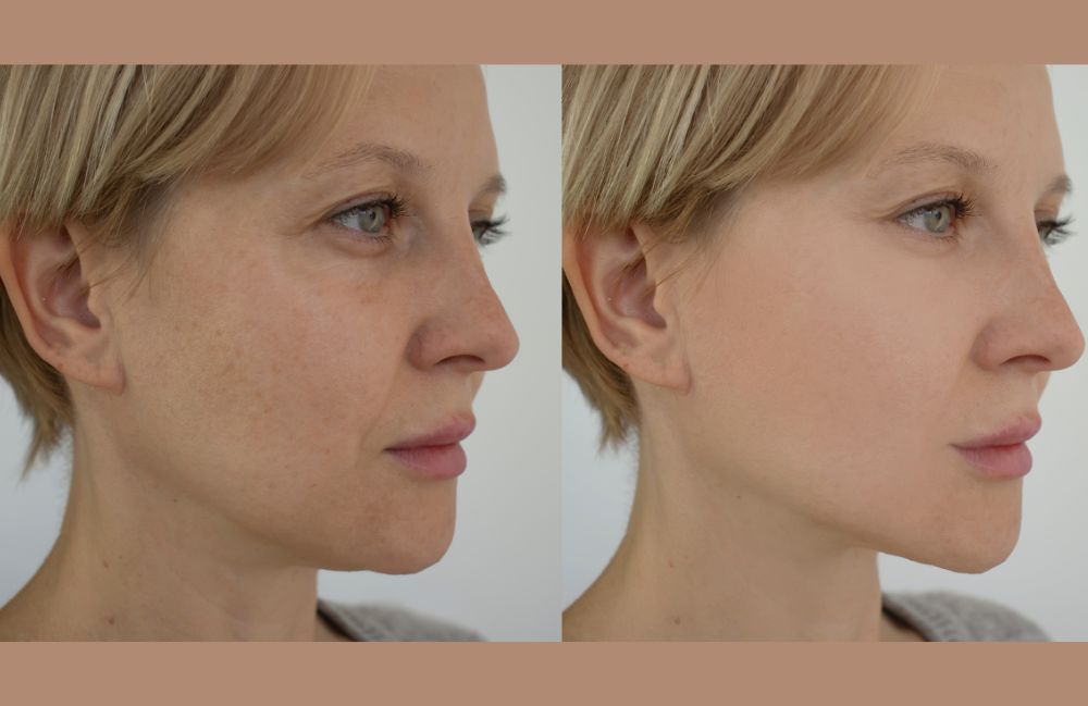 sunspot-removal-before-after-results Side-by-side comparison of a woman's neck before and after platysmal band injections.