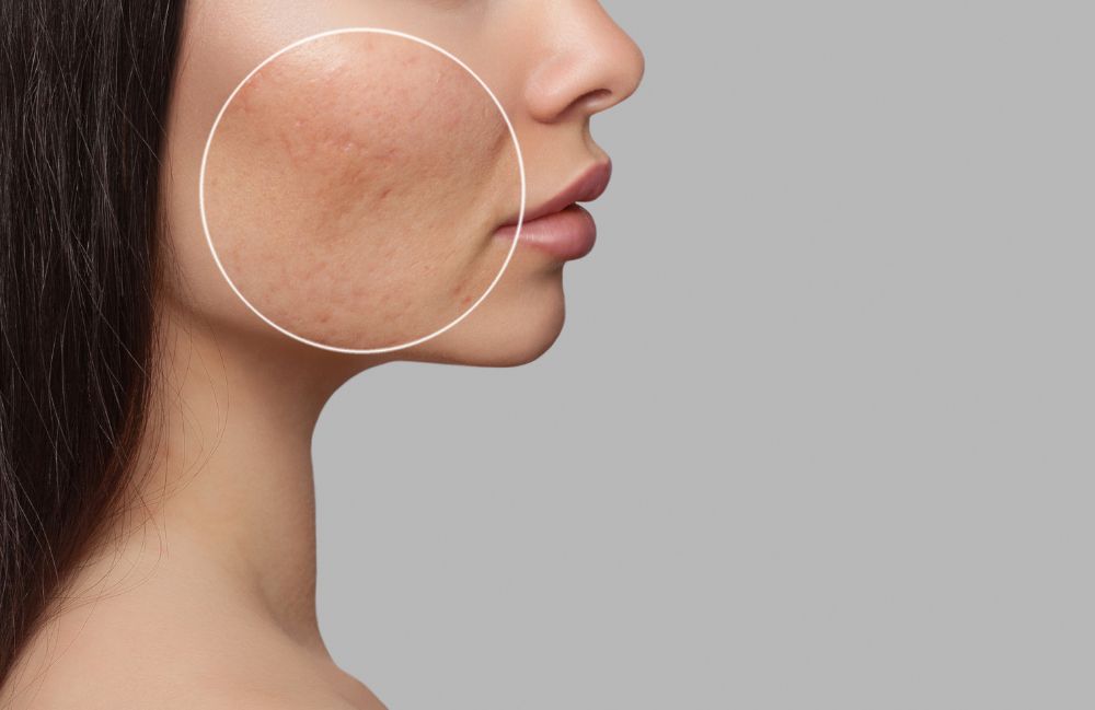 tca-cross-scar-treatment-face Close-up of a woman's neck showing visible platysmal bands before treatment.