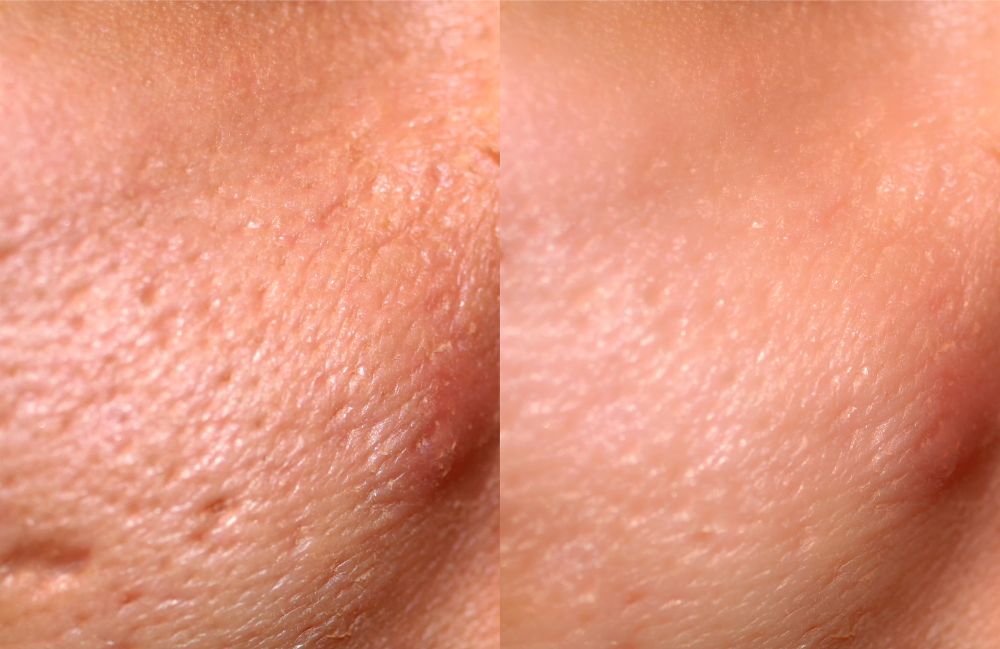 tca-cross-scar-treatment-results Side-by-side comparison of a woman's neck before and after platysmal band injections.