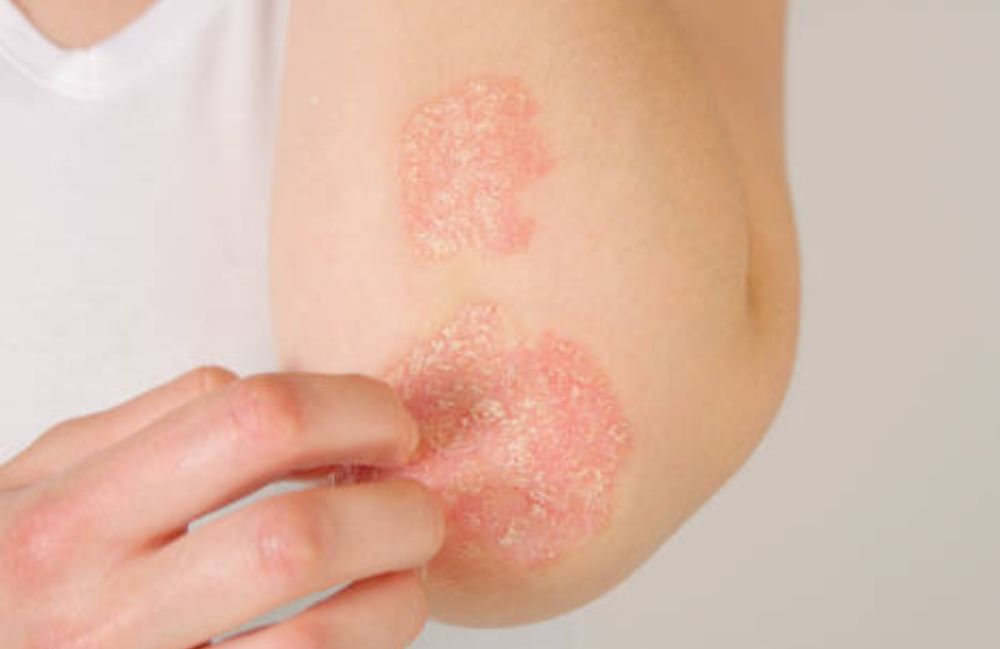 xtrac-excimer-laser-psoriasis Side-by-side comparison of a woman's neck before and after platysmal band injections.