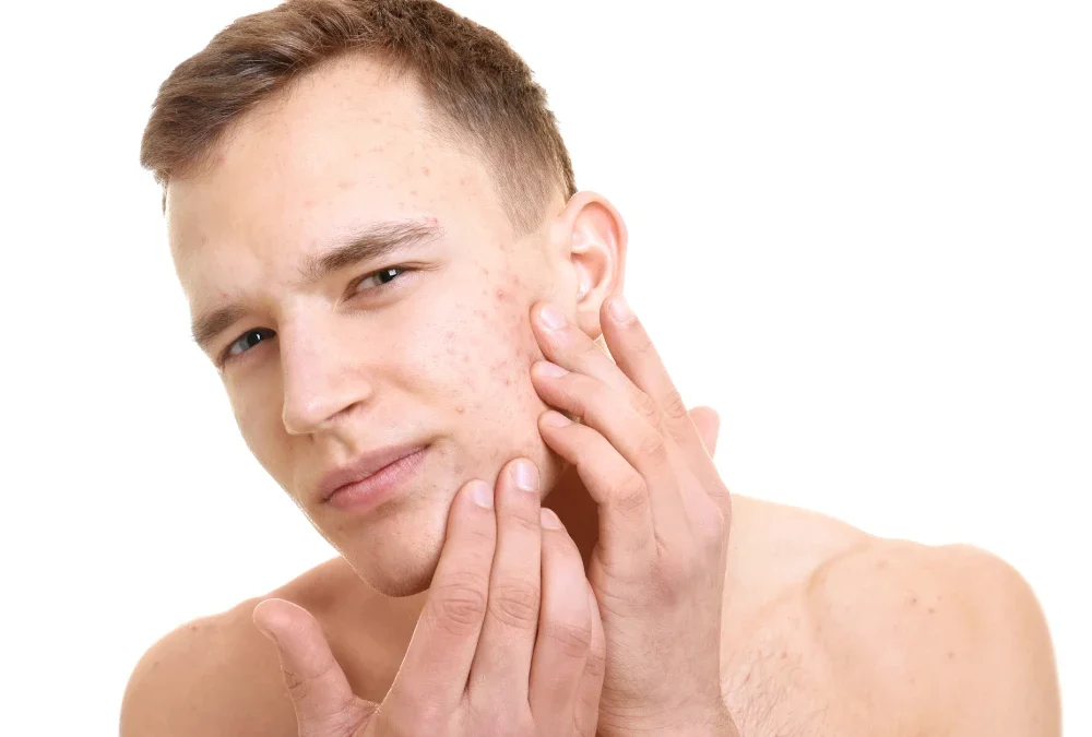 Dermatology acne facial check on man