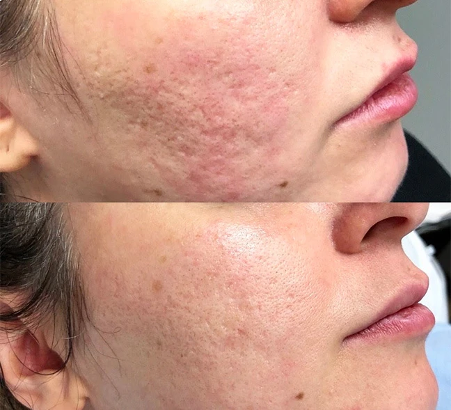 Dermatology acne before and after treatment