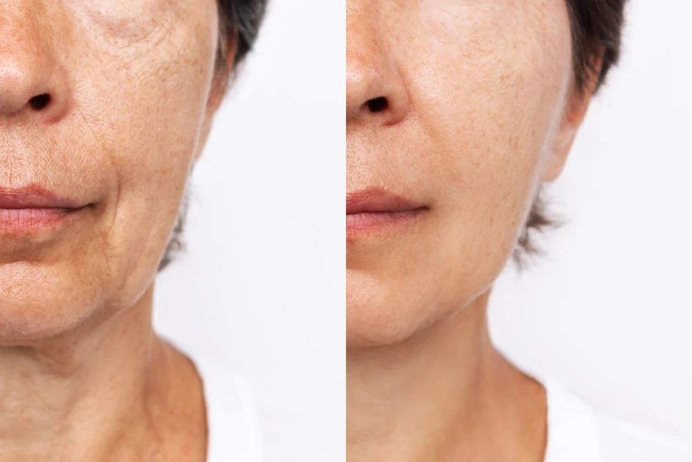 Side-by-side comparison of a woman’s face before and after receiving fillers.