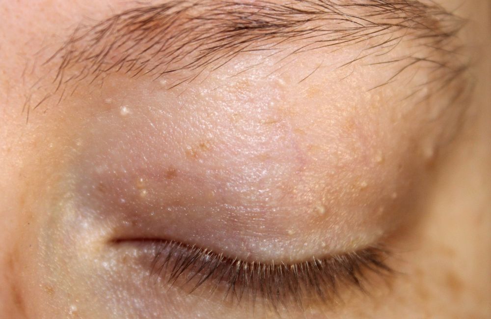 Side-by-side comparison of a woman's neck before and after platysmal band injections.