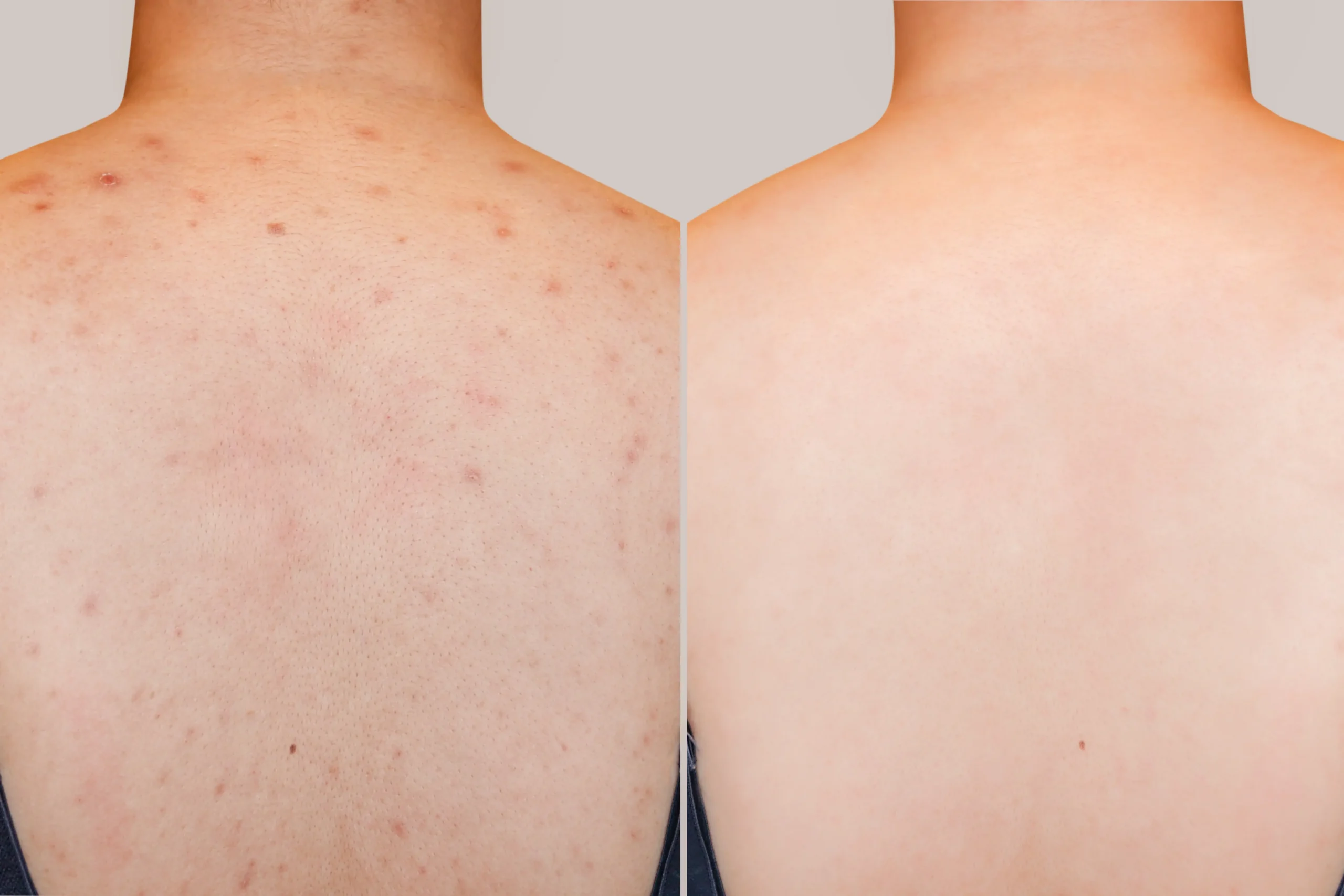 Left and right images compare a back with visible acne spots and a back with fewer visible marks.