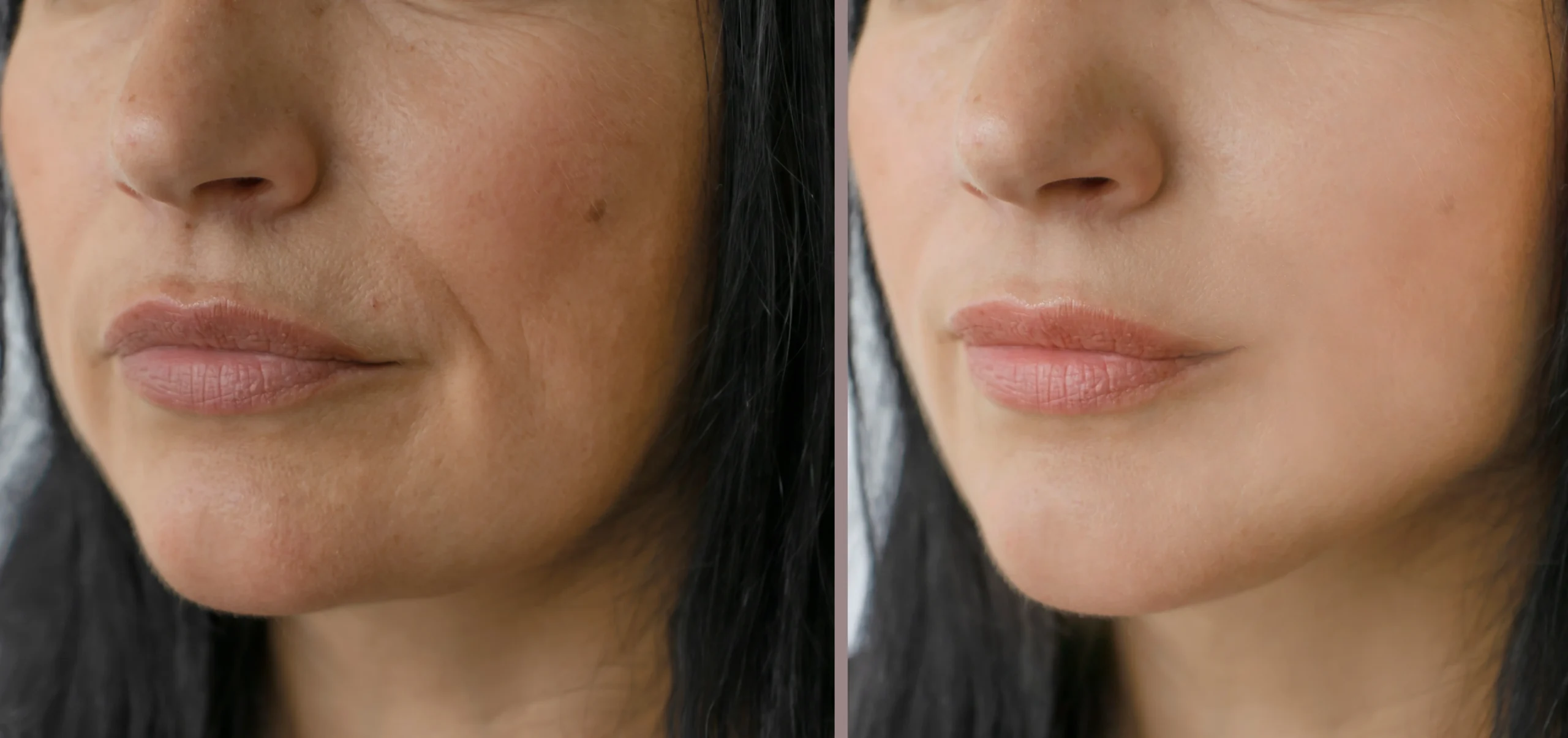 Left and right facial images compare visible cheek and jawline skin texture with fewer fine lines on the right.
