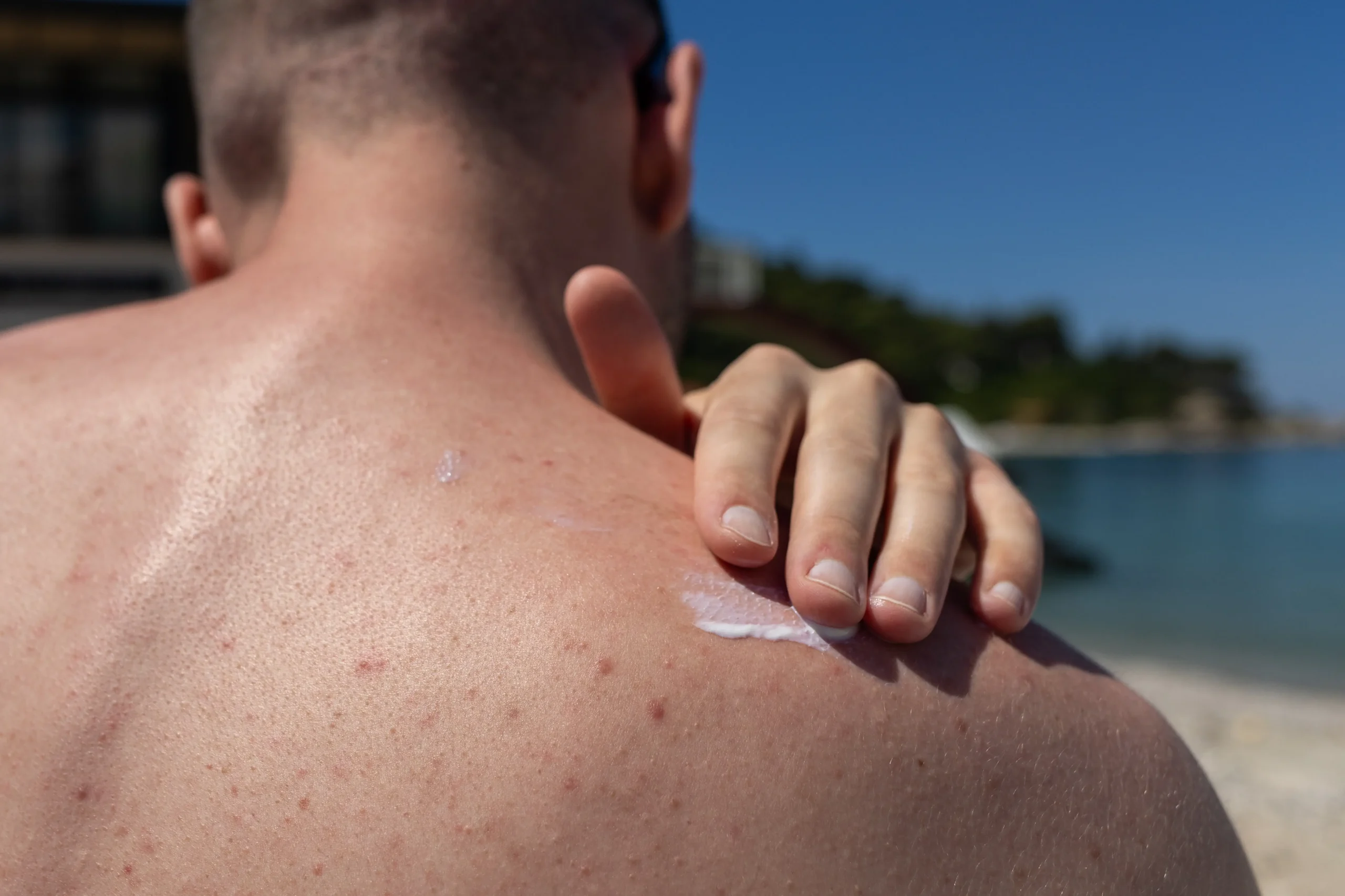 Person applies sunscreen to a back with visible acne spots while outdoors near the water.